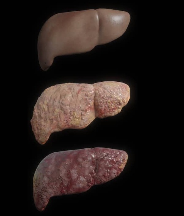 Liver — healthy, fatty and cancer-affected