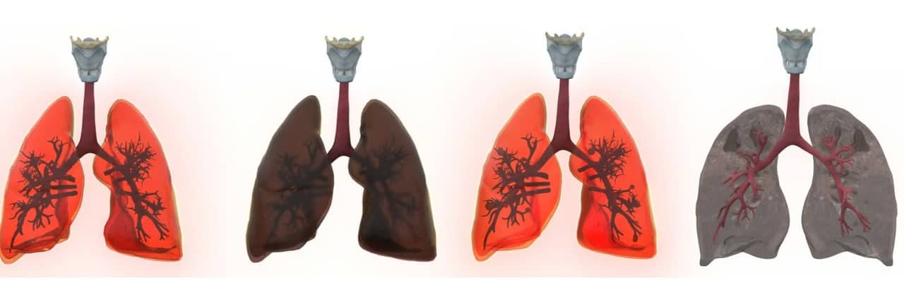 Four lungs compared — healthy, smoker's, virus-affected and tuberculosis-affected