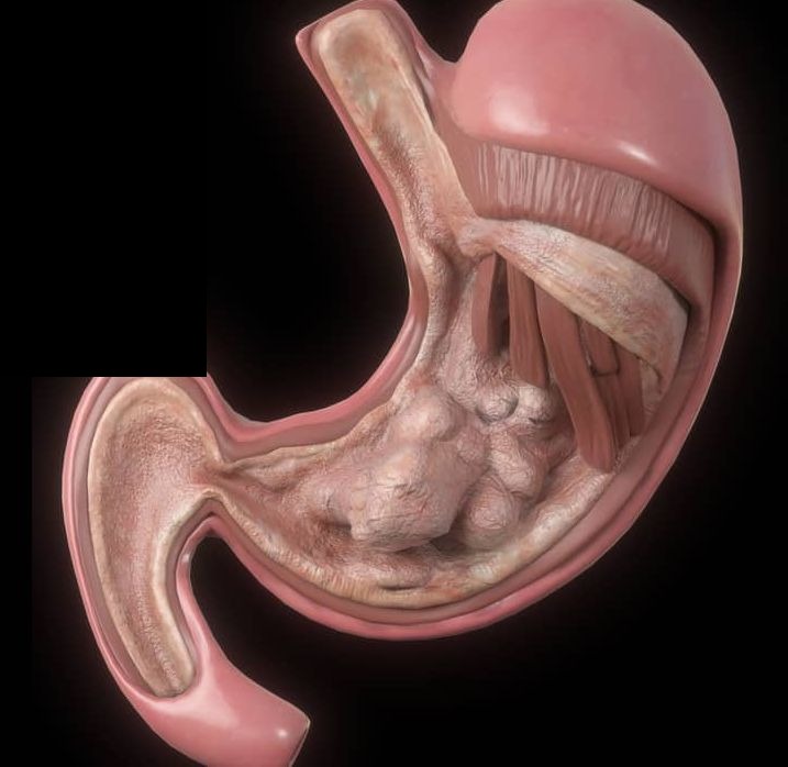 Stomach — abnormal tissue growth