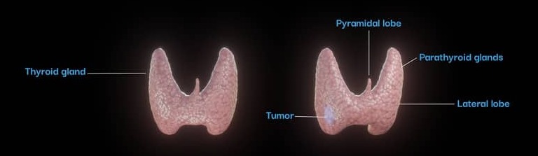 Thyroid — healthy gland beside a tumour-affected one