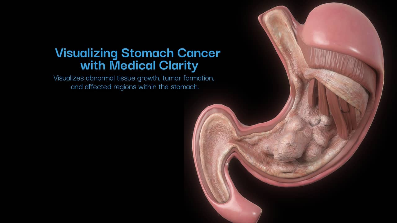 Stomach cancer