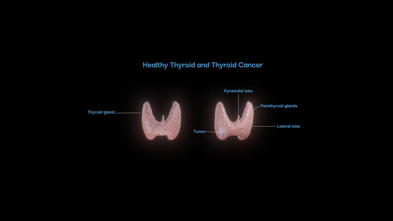 Thyroid — healthy to cancer